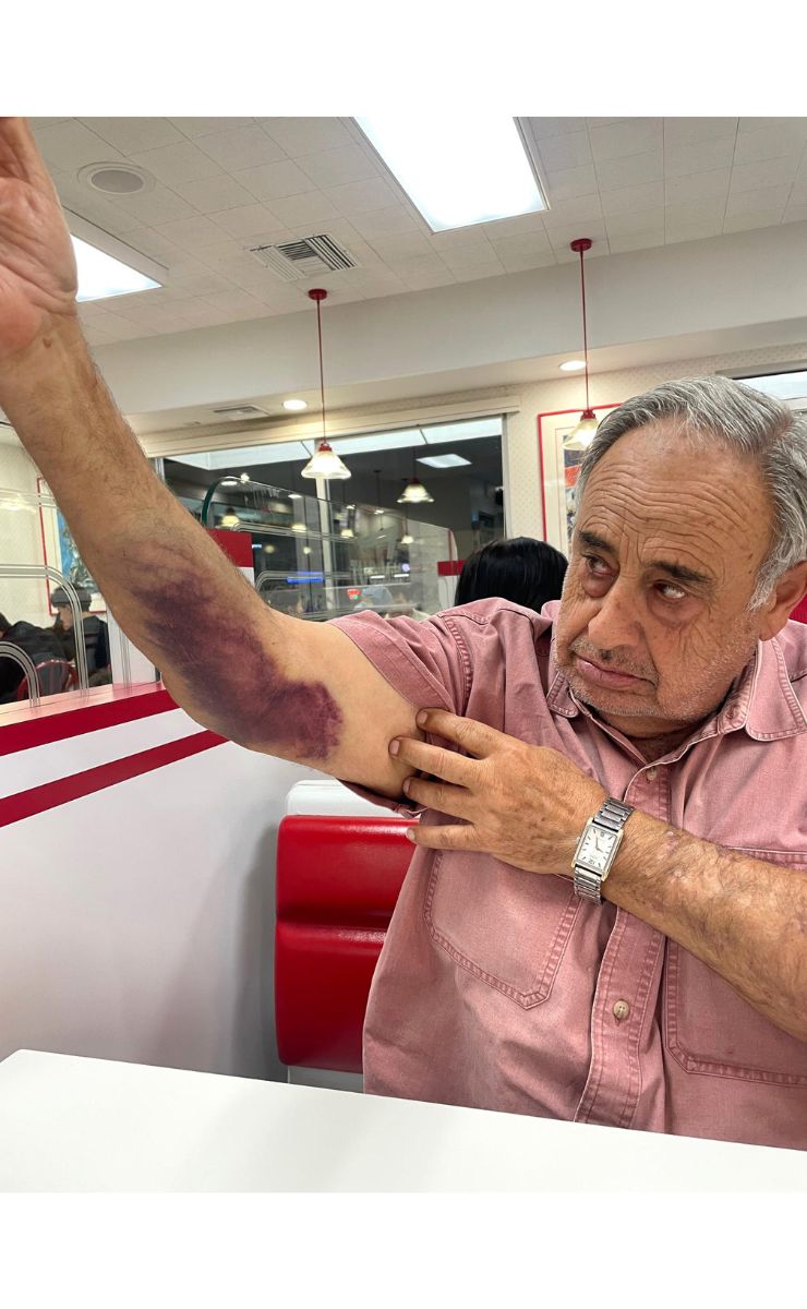 Trump acumula demandas millonarias por detención de ciudadanos en redadas - rafie-ollah-shouhed-muestra-las-lesiones-que-le-causaron-en-su-detencion-por-agentes-migratorios