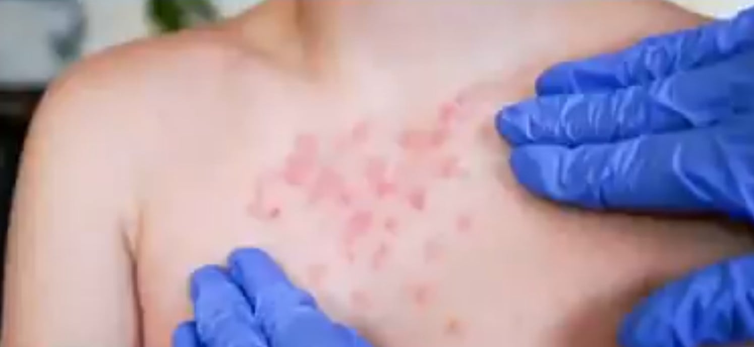 3mhl2gnhoraw7jcmmweongr33u-1 CDMX precisa edad del menor fallecido por sarampión