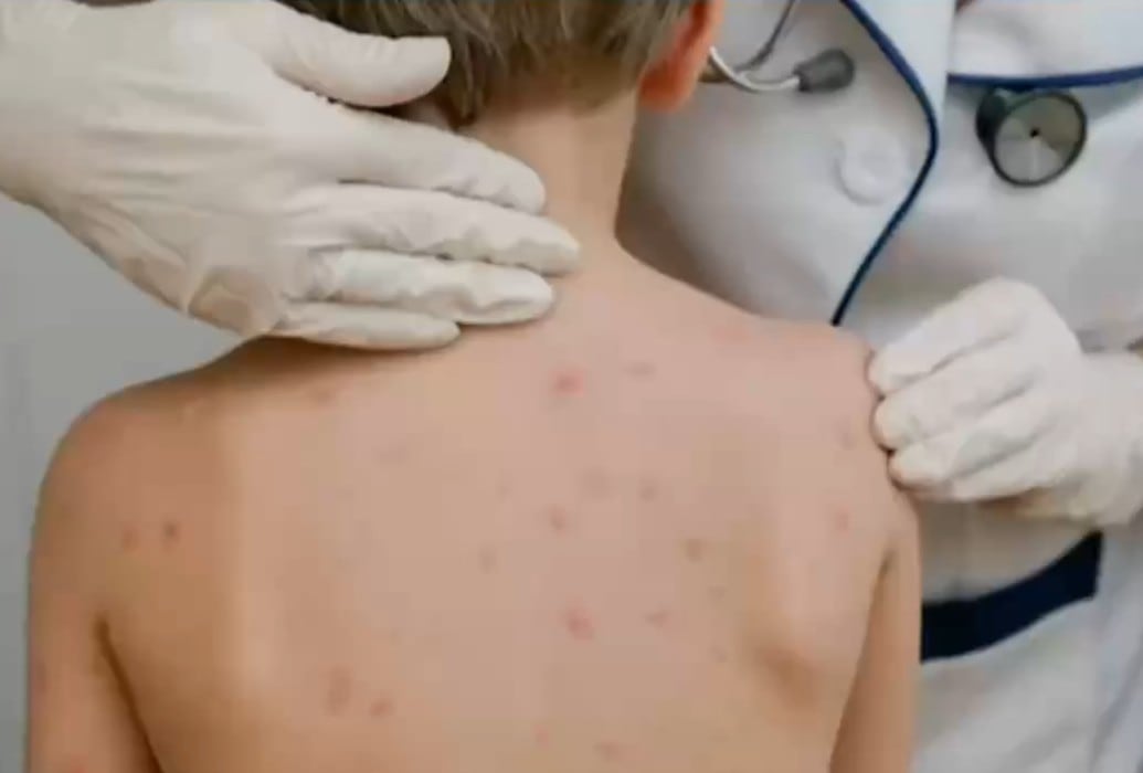 m7xdvdswobh6ndp5a4bkzb7isu-3 CDMX precisa edad del menor fallecido por sarampión